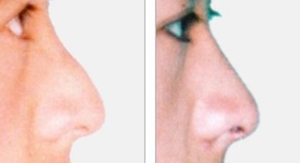 鼻头垂肉是什么样子的【鼻头有垂肉是什么样子】
