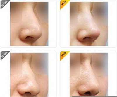 鼻子打玻尿酸为什么会变宽「鼻子打玻尿酸为什么会肿」