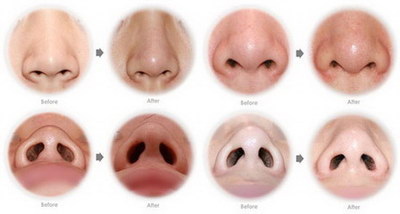 鼻中隔偏曲双侧下鼻甲肥大手术_鼻中隔偏曲右侧下鼻甲肥大手术