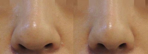 缩鼻翼手术前后对比照「缩鼻翼手术前后对比」