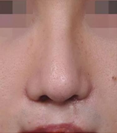 做完隆鼻手术一年后鼻头青(膨体隆鼻手术一年后变形)