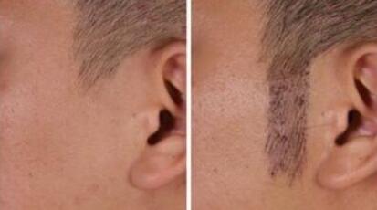 鬓角脱发是什么原因造成的【鬓角脱发是什么原因引起的】