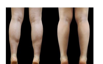 肌肉腿可以瘦下来吗(遗传肌肉腿可以瘦下来吗)
