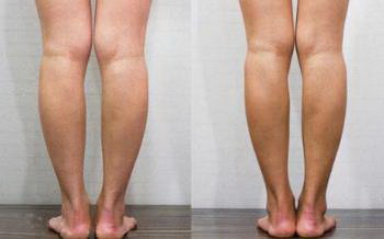 大腿抽脂手术后多久可以同房(手术后需要恢复一段时间)