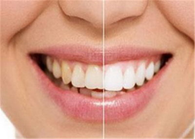 修复牙齿缝隙的方法「修复牙齿缝隙的最佳方法」
