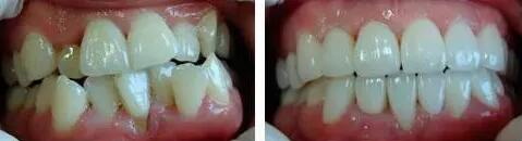 日常美白牙齿的十个方法(日常美白牙齿的小窍门)