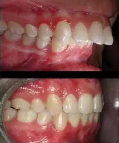磷是构成骨骼牙齿的主要成分吗_儿童牙齿早期干预最大可以几岁