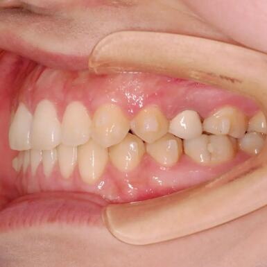 龅牙带牙套多久可以看到效果(龅牙带牙套多久可以排齐)