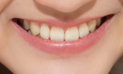 拔牙打麻药会不会伤到牙神经_拔牙碰到牙神经多久可以修复