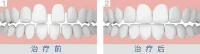 种植牙植骨的成功率是多少「种植牙植骨成功率有多少」