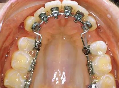 根管治疗后牙疼是什么原因_根管治疗后牙疼是怎么回事