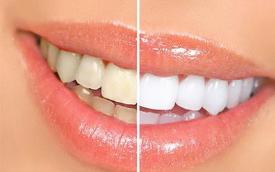 牙齿表面上有黑渍怎么去除_洗牙之后牙齿表面上有个坑
