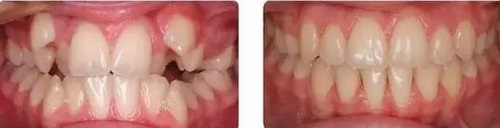 牙齿缝隙变大治疗方法(牙齿缝隙宽治疗方法)