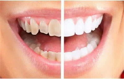 洗牙能使牙齿变白吗[洗牙能把牙齿变白吗]