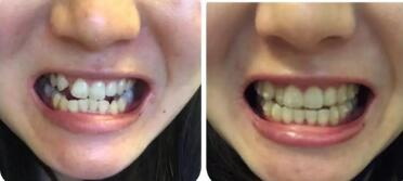牙齿矫正为什么一个月调整一次[牙齿矫正为什么一个月调整一次需要洗牙吗]