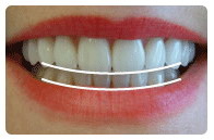 牙齿光固化修复