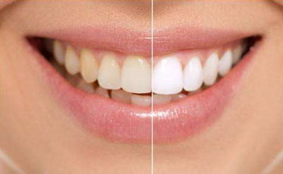 牙黄可以通过洗牙变白吗(牙黄可以通过洗牙解决吗)