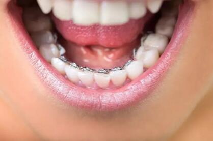 门牙蛀牙需要根管治疗吗【门牙蛀牙要根管治疗吗】