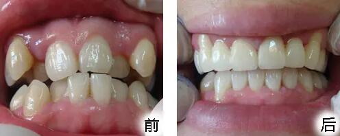 上海九院种植牙最好的医生「上海哪里做种植牙技术最好」
