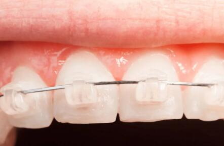 牙龈缝了针要注意什么_牙龈缝合拆线后注意什么