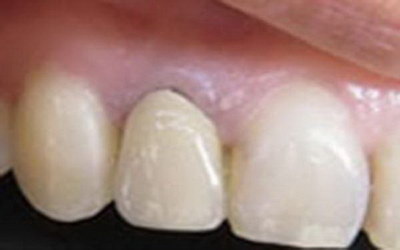 牙齿内漂白能保持多久「漂白牙齿能保持多久」