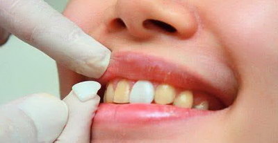 发现牙齿有裂痕怎么办_吃柠檬牙齿酸怎么缓解