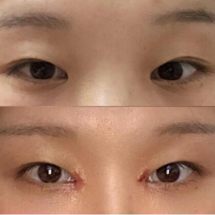 韩式定点双眼皮为什么不需要拆线_做完韩式定点双眼皮需要注意什么