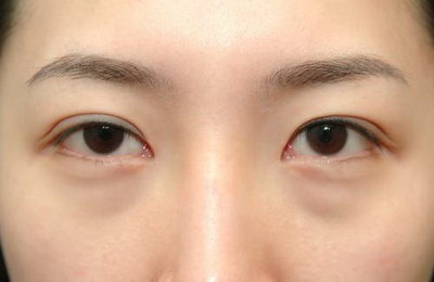 割双眼皮手术一般有几个医生(一般做双眼皮手术用哪些药)