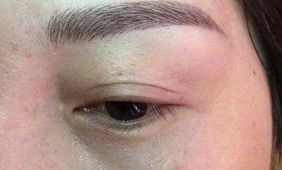 双眼皮手术后水肿怎么消除_做双眼皮手术后上眼皮水肿