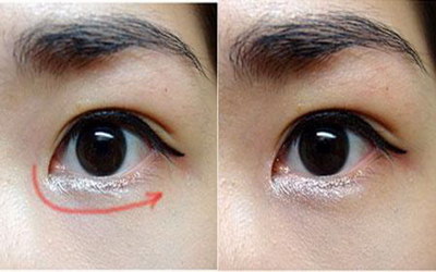 外切去眼袋手术后多久能用眼霜(外切去眼袋手术后多久脱痂)