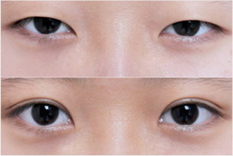 北京手术割双眼皮(北京割双眼皮手术安全吗)