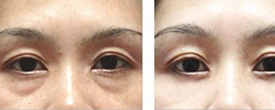 双眼皮埋线多久能恢复正常