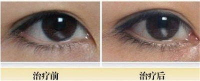 定点双眼皮术后注意事项_做定点双眼皮过程