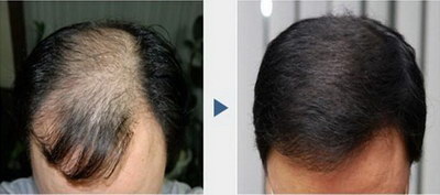 天津种植头发哪家不错「天津种植头发哪家好首选健洁可信」