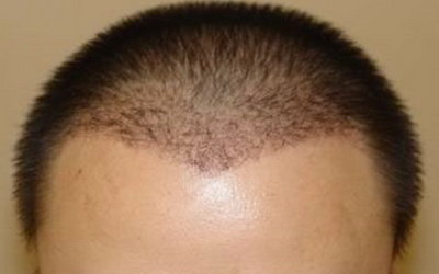 头发毛囊胚胎移植靠谱吗「长春头发毛囊医院」
