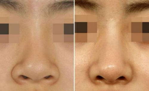 鼻部整形修复手术前后对比效果(鼻部整形手术修复时间)