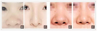 鼻子缩小手术多久能恢复