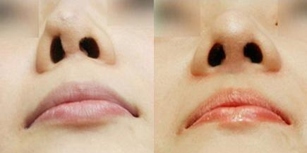 假体隆鼻恢复过程是怎样的_济南假体隆鼻恢复过程