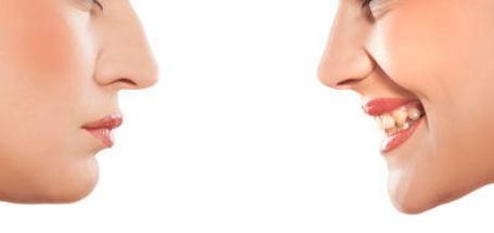 玻尿酸隆鼻会导致眼睛疼吗