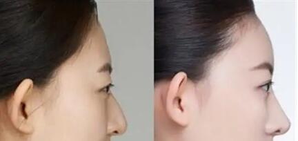 耳软骨垫鼻尖什么情况下需要取出_耳软骨垫鼻尖什么时候才消肿完