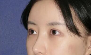 鼻子缩小手术前后对比照_广州紫 馨鼻子缩小