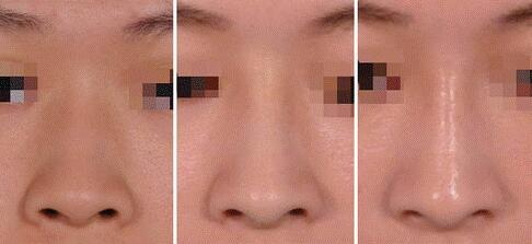鼻综合后多久鼻子会软_鼻综合取出后鼻子需要多久稳定