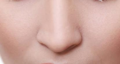 隆鼻什么时候会出现排异反应_隆鼻山根什么时候能贴合