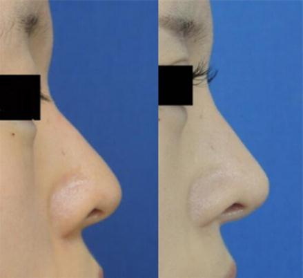 隆鼻后会影响鼻腔的正常功能吗
