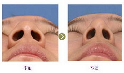 耳软骨隆鼻过程多久_耳软骨隆鼻过程视频
