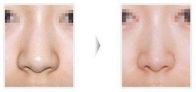隆鼻假体修复手术方式