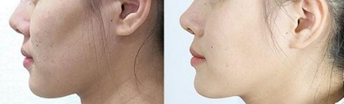 耳软骨隆鼻需要多长时间恢复「双侧耳软骨隆鼻需要多长时间做好」