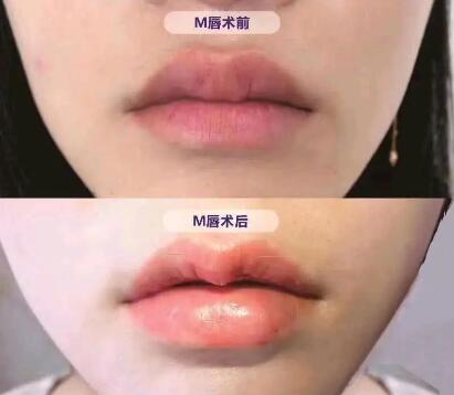嘴唇周围长斑是什么原因造成的_嘴唇周围长痘痘的原因及处理方法