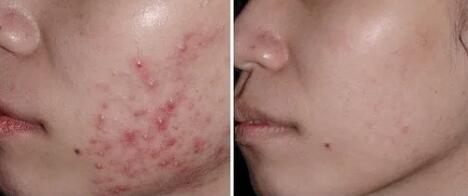 疤痕皮肤可以做激光祛斑吗(疤痕性皮肤可以做激光祛斑吗)