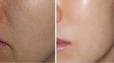 点痣脱痂后多久可以用护肤品_脸上点痣后多久可以擦护肤品